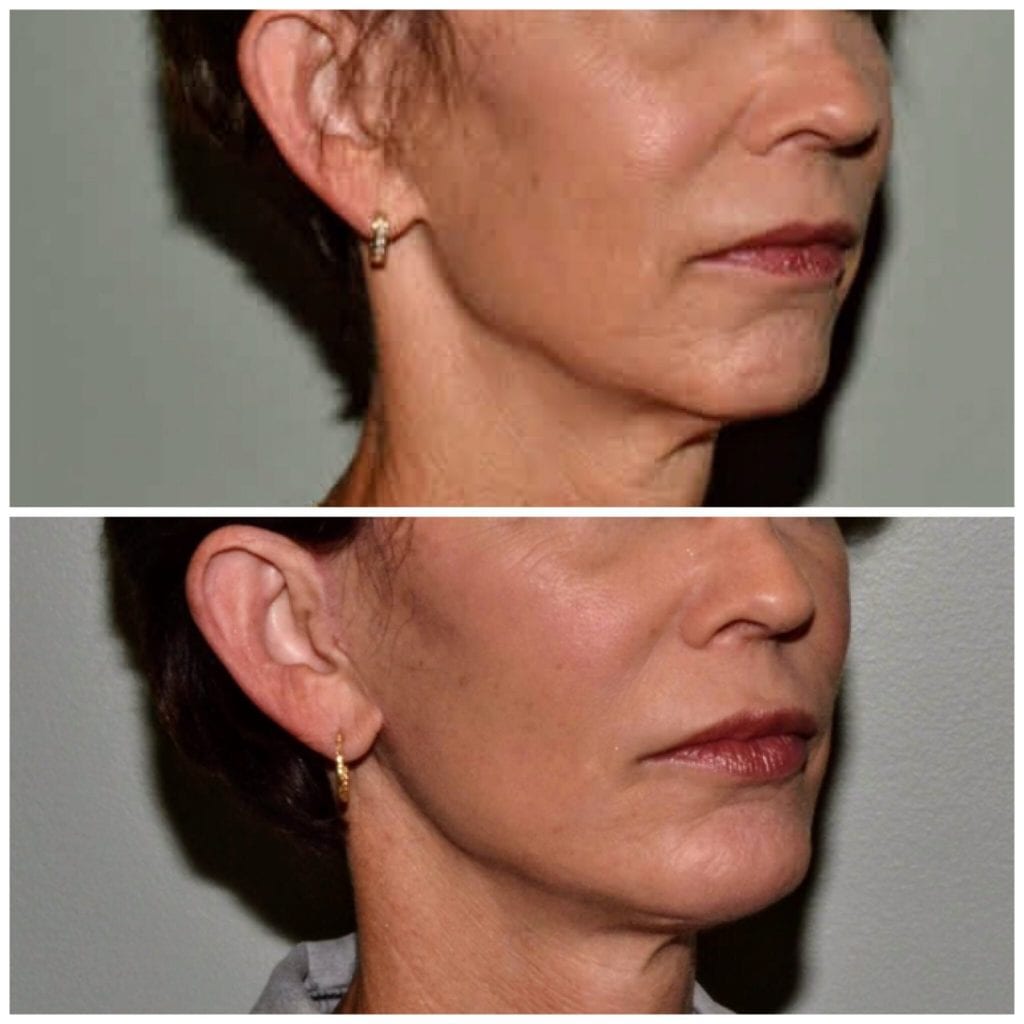 Facelift Daytona Beach Facelift Facelift Port Orange Ormond Beach Facelift Before and After Facelift Daytona Beach Before and After Facelift Port Orange Best Facelift Plastic Surgeon Volusia County Dr. Samson Facelift Before and After Facelift Plastic Surgeon Near Me