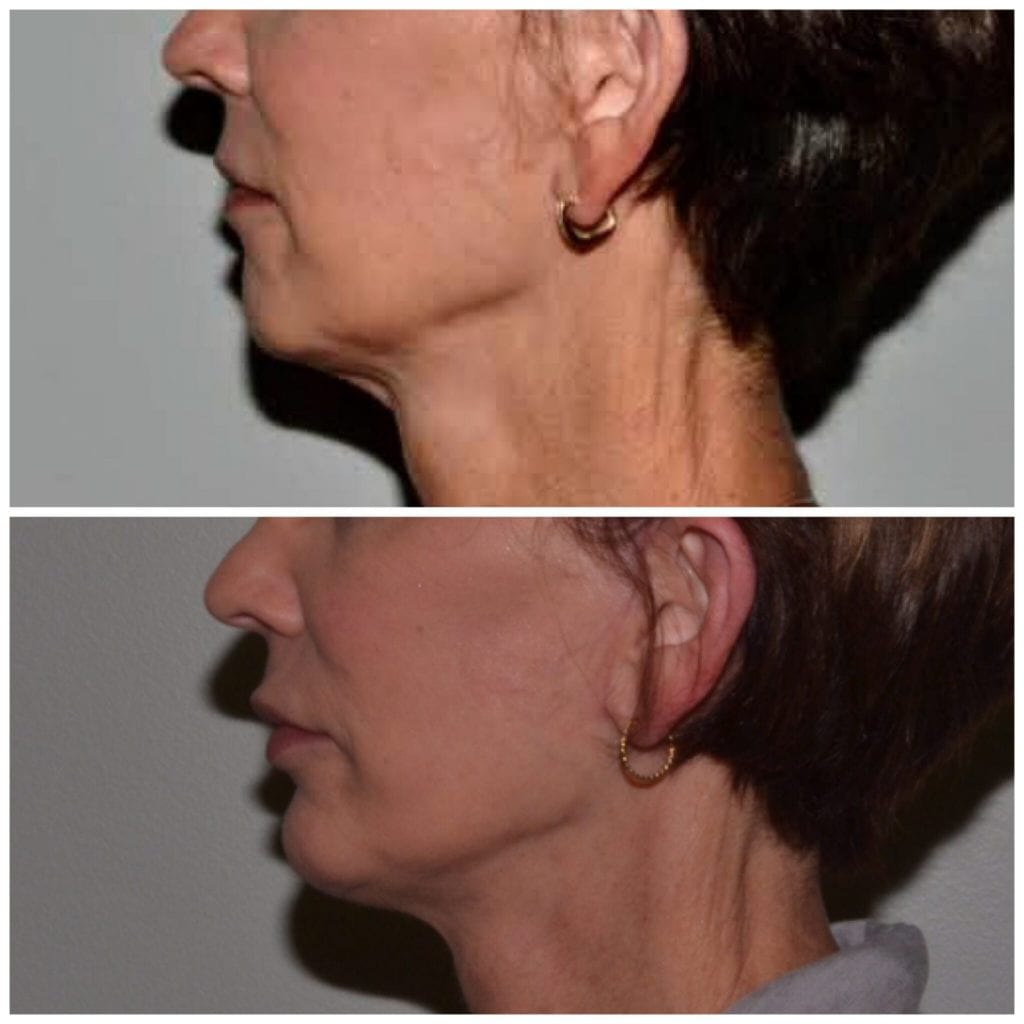 Facelift Daytona Beach Facelift Facelift Port Orange Ormond Beach Facelift Before and After Facelift Daytona Beach Before and After Facelift Port Orange Best Facelift Plastic Surgeon Volusia County Dr. Samson Facelift Before and After Facelift Plastic Surgeon Near Me