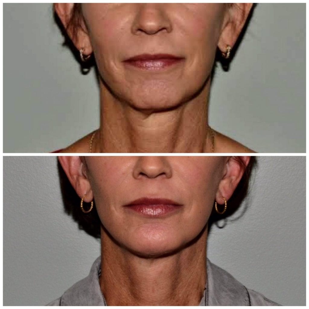 Facelift Ormond Beach, Port Orange Facelift