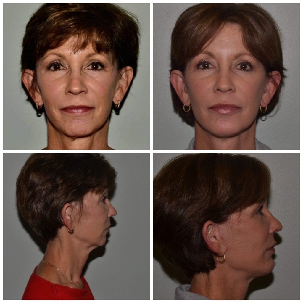 Facelift Daytona Beach Ormond Beach Facelift Port Orange Facelift