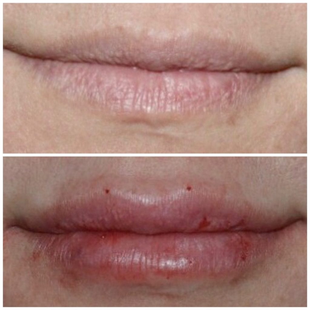 Lip Injections/Lip Filler/Juvederm Daytona Beach Lip Filler Injections Juvederm Lip Filler Injections Juvederm Port Orange Ormond Beach Lip Filler Injections Before and After Lip Filler Daytona Beach Before and After Lip Injections Port Orange Before and After Lip Filler Injections Ormond Beach Best Lip Filler Plastic Surgeon Volusia County Dr. Samson Lip Fillers Before and After Lip Fillers Plastic Surgeon Near Me Botox Bar Juvederm Injections Daytona Beach