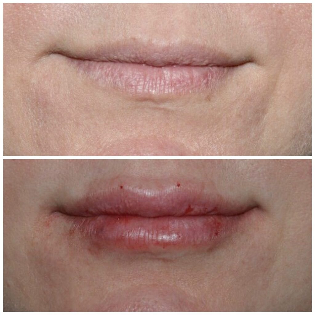 Lip Injections/Lip Filler/Juvederm Daytona Beach Lip Filler Injections Juvederm Lip Filler Injections Juvederm Port Orange Ormond Beach Lip Filler Injections Before and After Lip Filler Daytona Beach Before and After Lip Injections Port Orange Before and After Lip Filler Injections Ormond Beach Best Lip Filler Plastic Surgeon Volusia County Dr. Samson Lip Fillers Before and After Lip Fillers Plastic Surgeon Near Me Botox Bar Juvederm Injections Daytona Beach
