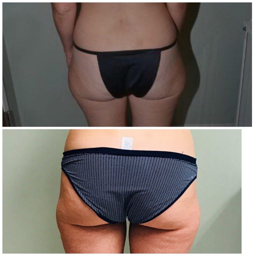 Lipo Butt, Liposuction Thighs, Liposuction Saddlebags, Lipo for Hips