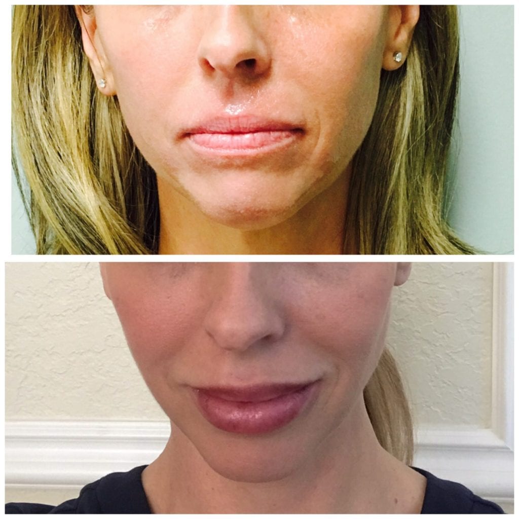Walk In Lip Filler Walk in Lip