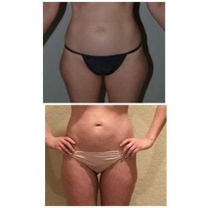 CoolSculpting Lipo