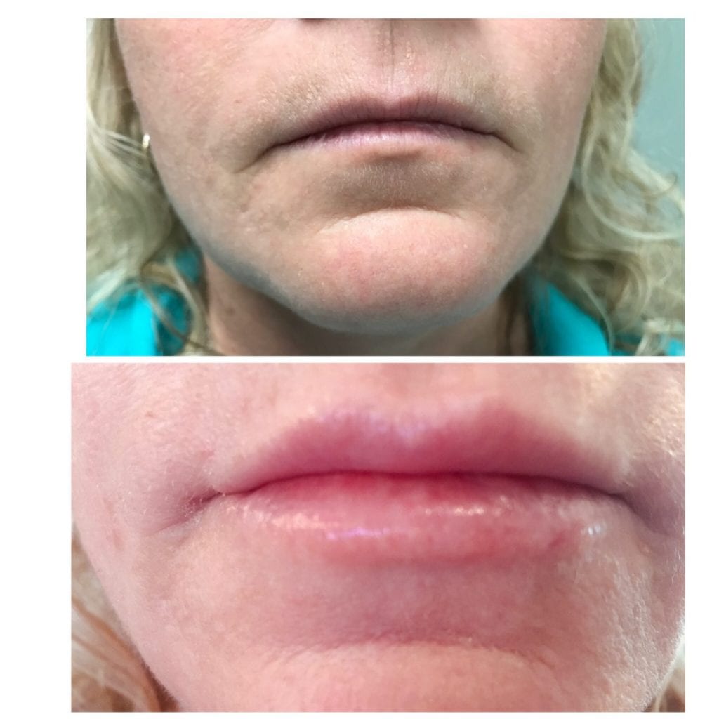 Lip Injections/Lip Filler/Juvederm Daytona Beach Lip Filler Injections Juvederm Lip Filler Injections Juvederm Port Orange Ormond Beach Lip Filler Injections Before and After Lip Filler Daytona Beach Before and After Lip Injections Port Orange Before and After Lip Filler Injections Ormond Beach Best Lip Filler Plastic Surgeon Volusia County Dr. Samson Lip Fillers Before and After Lip Fillers Plastic Surgeon Near Me Botox Bar Juvederm Injections Daytona Beach