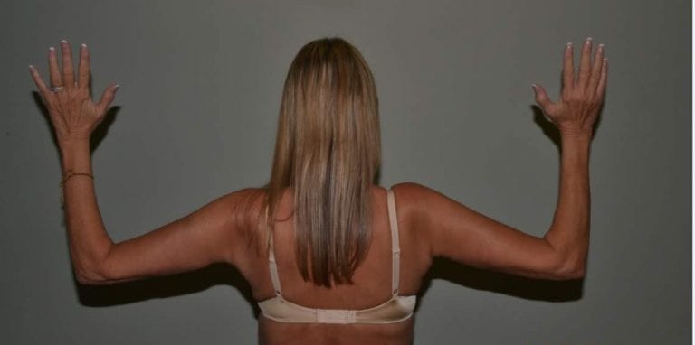 Daytona Beach Arm Lift Brachioplasty