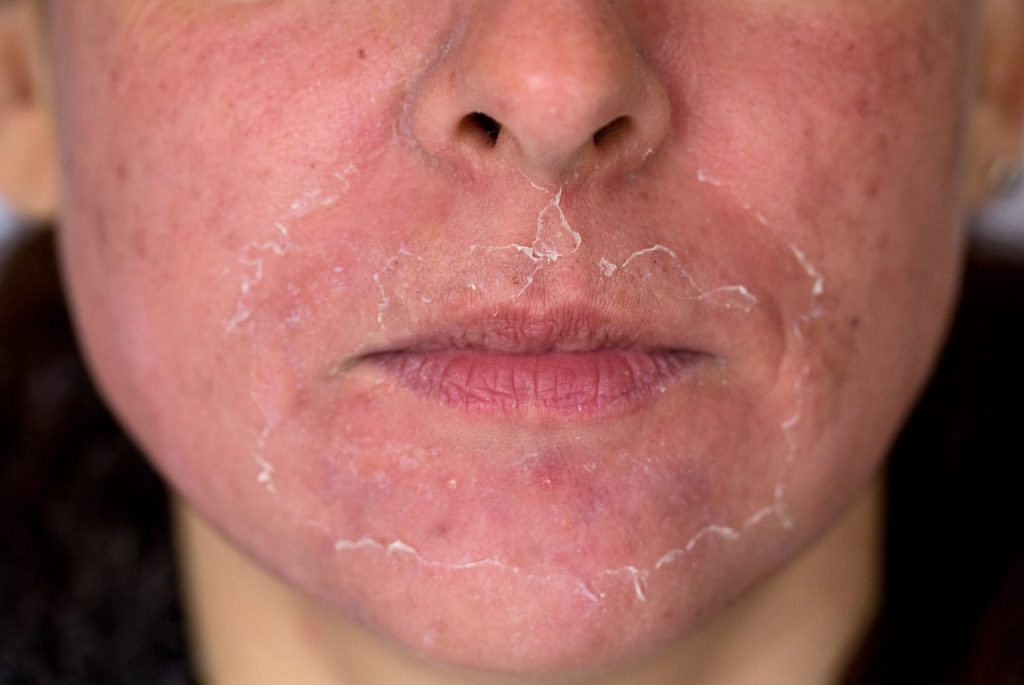 VI PEEL