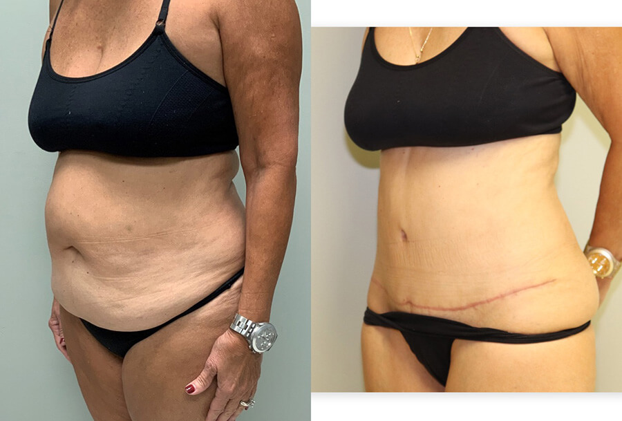 Tummy Tuck