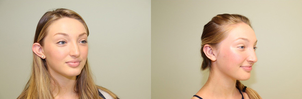 Otoplasty Patient 1