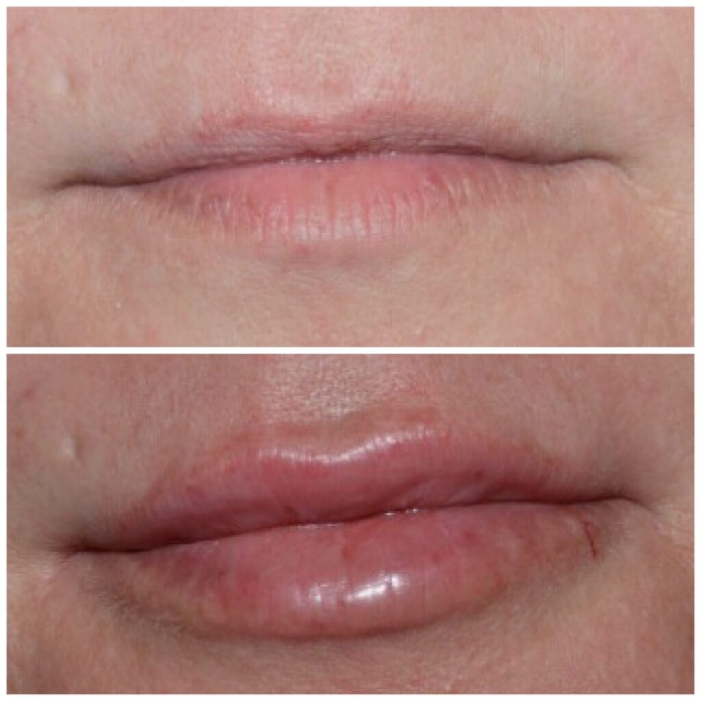 Lip Injections/Lip Filler/Juvederm Daytona Beach Lip Filler Injections Juvederm Lip Filler Injections Juvederm Port Orange Ormond Beach Lip Filler Injections Before and After Lip Filler Daytona Beach Before and After Lip Injections Port Orange Before and After Lip Filler Injections Ormond Beach Best Lip Filler Plastic Surgeon Volusia County Dr. Samson Lip Fillers Before and After Lip Fillers Plastic Surgeon Near Me Botox Bar Juvederm Injections Daytona Beach