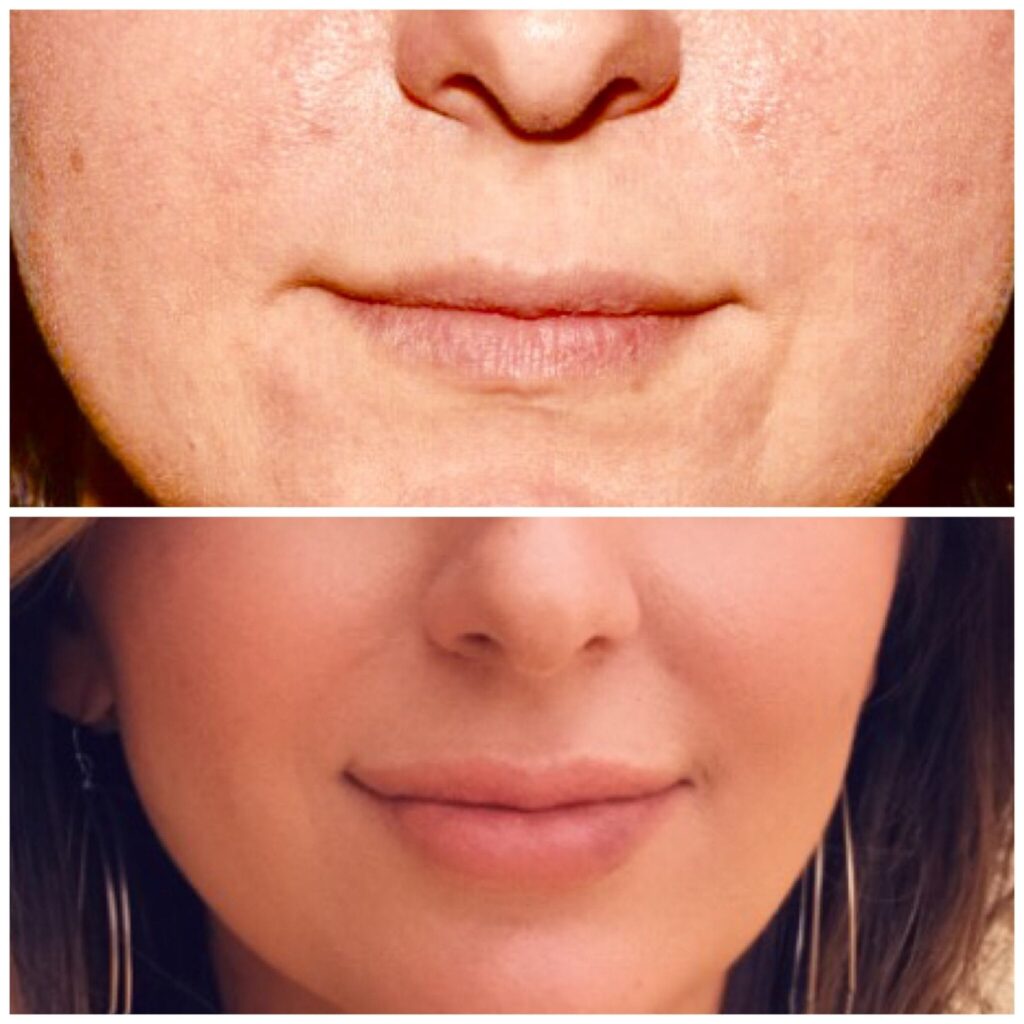 Lip Injections/Lip Filler/Juvederm