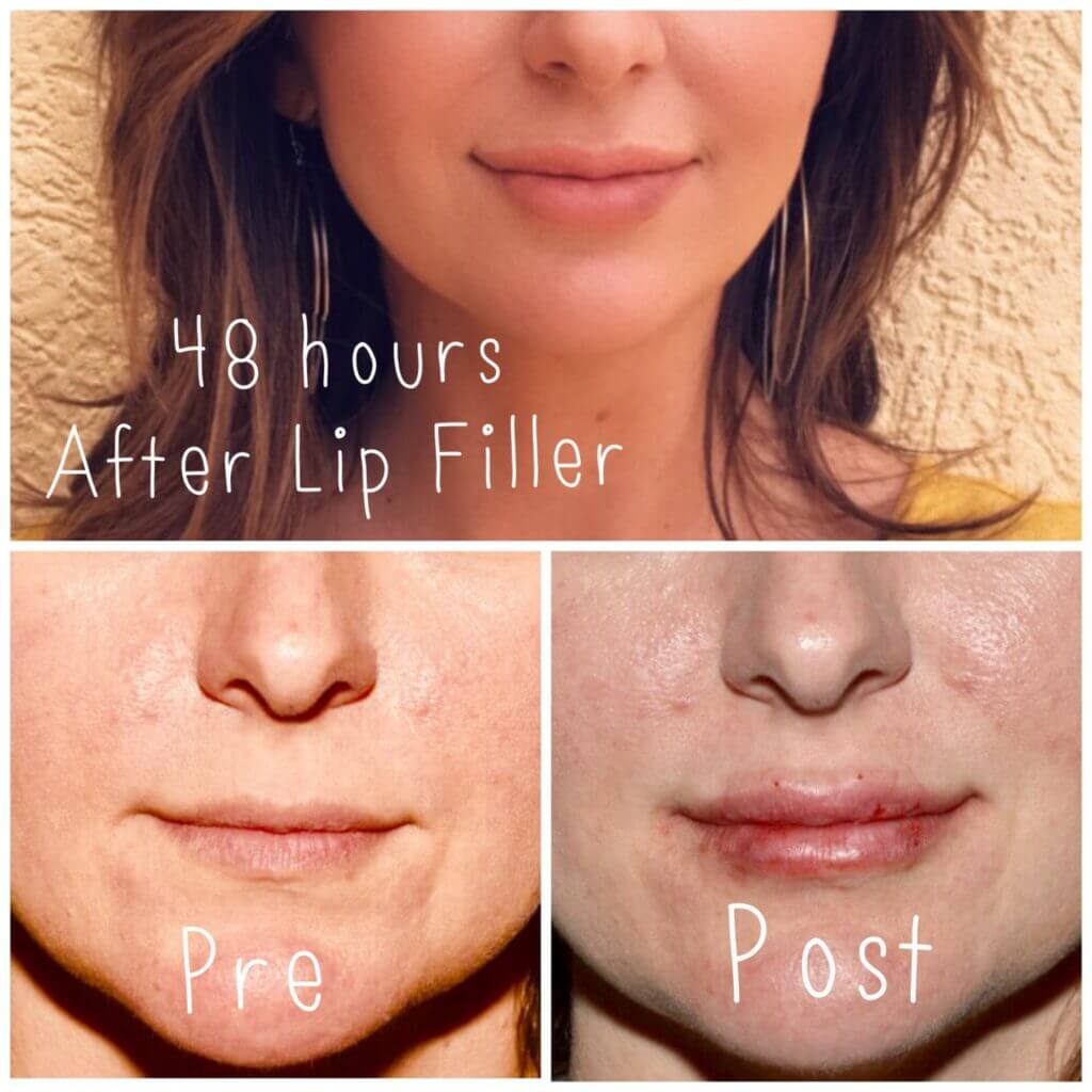 Lip Filler Cost, Best Lip Filler Injector