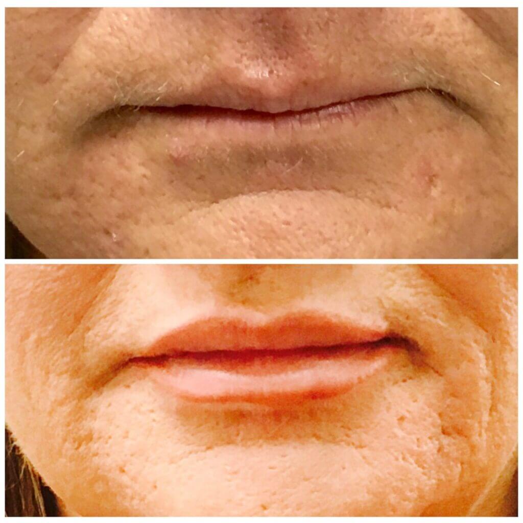 Lip Injections/Lip Filler/Juvederm Daytona Beach Lip Filler Injections Juvederm Lip Filler Injections Juvederm Port Orange Ormond Beach Lip Filler Injections Before and After Lip Filler Daytona Beach Before and After Lip Injections Port Orange Before and After Lip Filler Injections Ormond Beach Best Lip Filler Plastic Surgeon Volusia County Dr. Samson Lip Fillers Before and After Lip Fillers Plastic Surgeon Near Me Botox Bar Juvederm Injections Daytona Beach