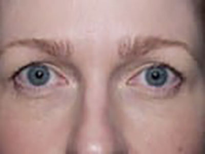 Brow Lift Before Patient 1