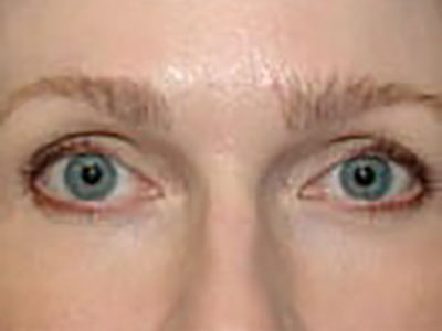 Brow Lift After Patient 1