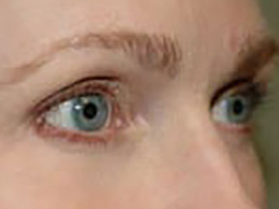 Brow Lift After Patient 2