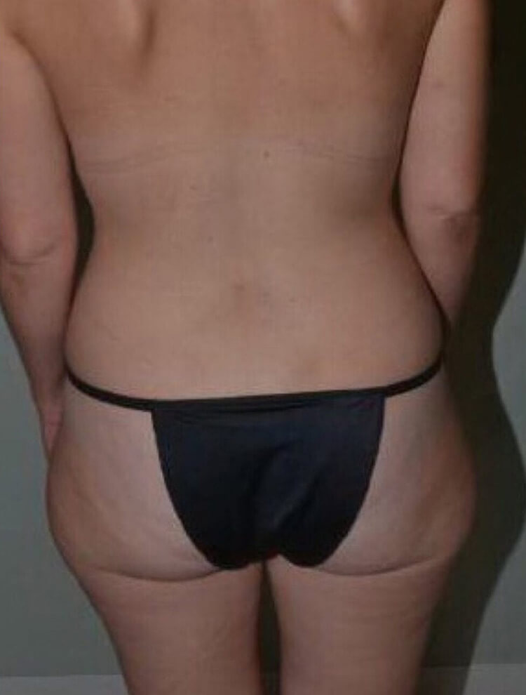 Liposuction Before Patient 1