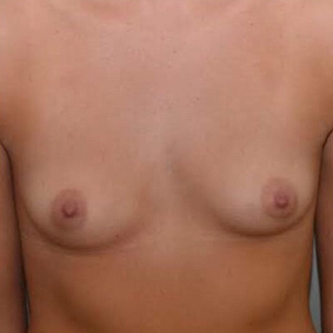 Breast Augmentation Before Patient 1