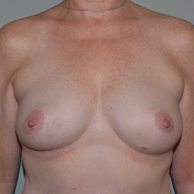 Breast Augmentation Before Patient 5