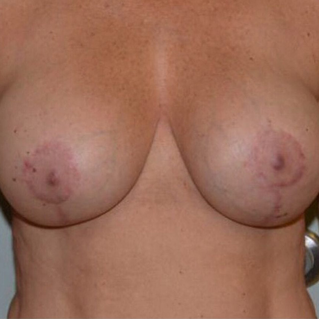 Breast Lift After Patient 1