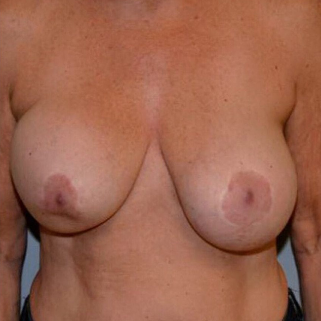 Breast Lift Before Patient 1