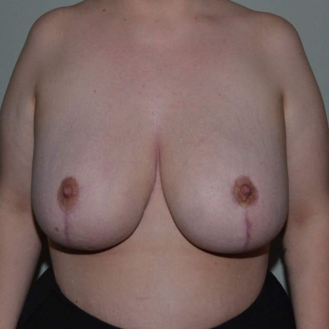 Breast Reduction Surgery After Patient 2