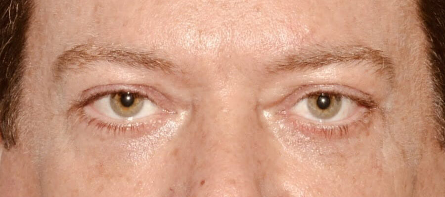 Eyelid Surgery After Patient 1