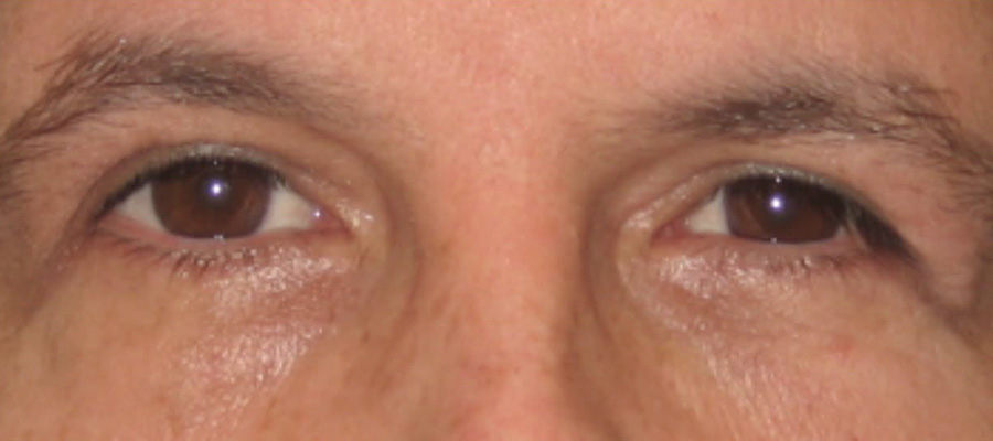 Eyelid Surgery After Patient 2