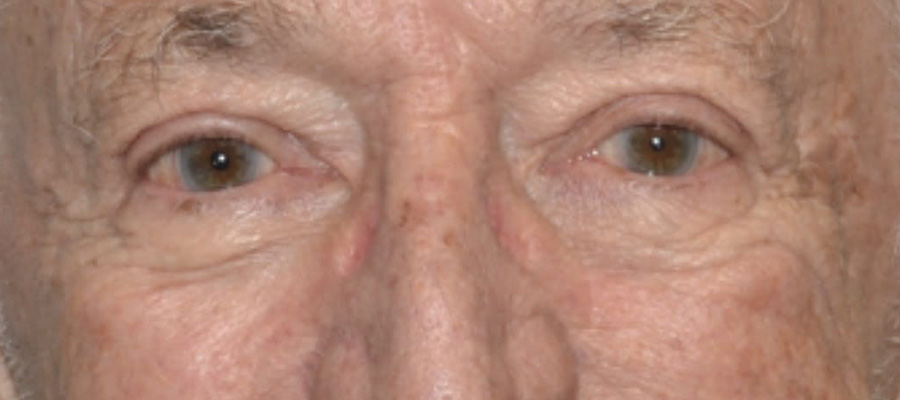 Eyelid Surgery After Patient 3