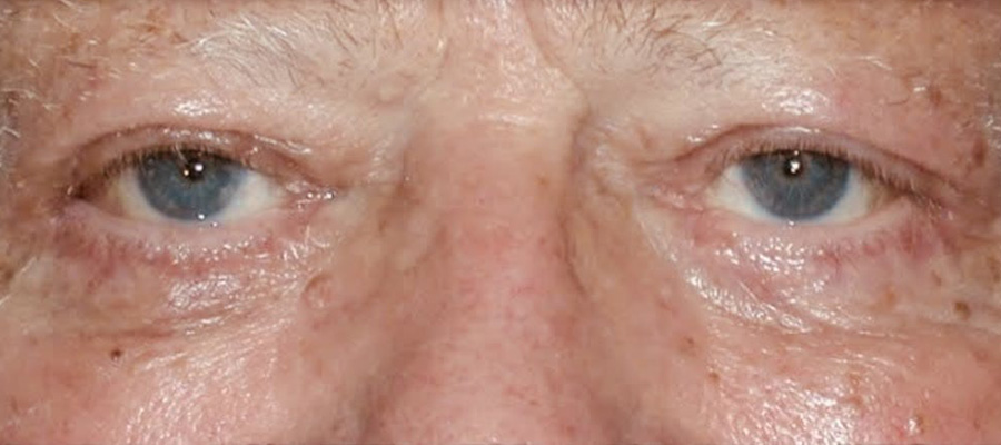 Eyelid Surgery After Patient 4