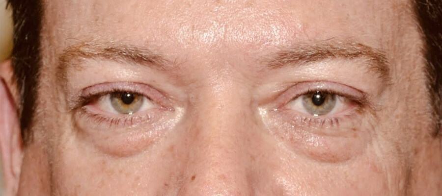 Eyelid Surgery Before Patient 1