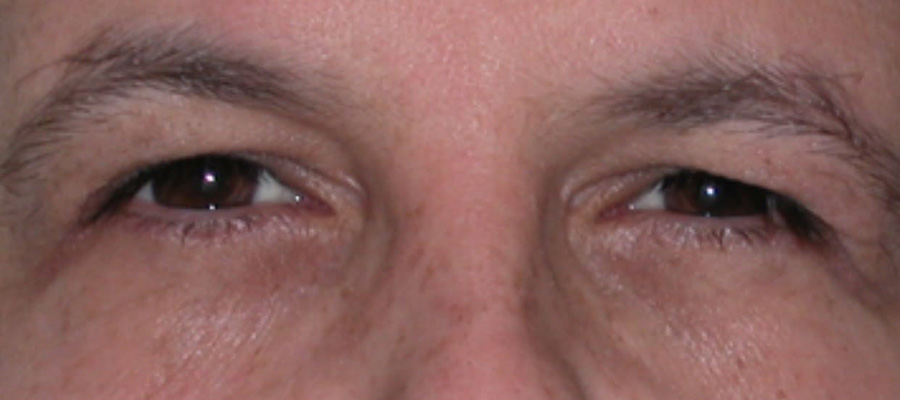 Eyelid Surgery Before Patient 2