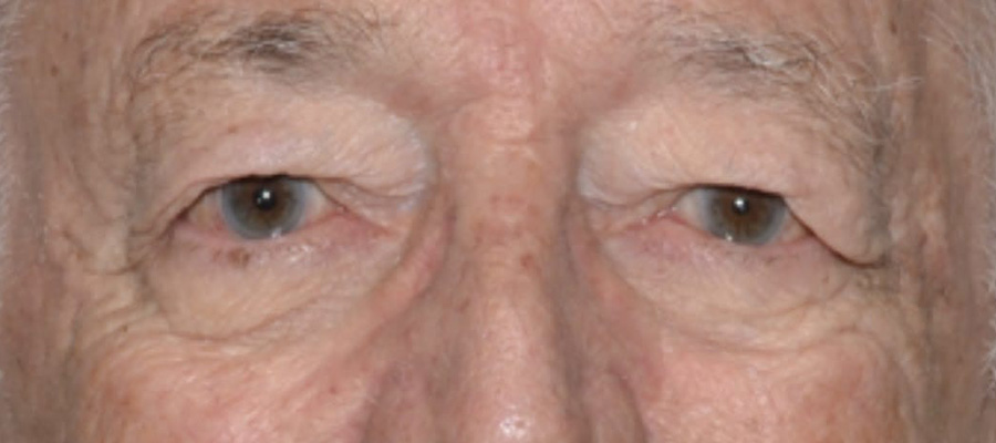 Eyelid Surgery Before Patient 3