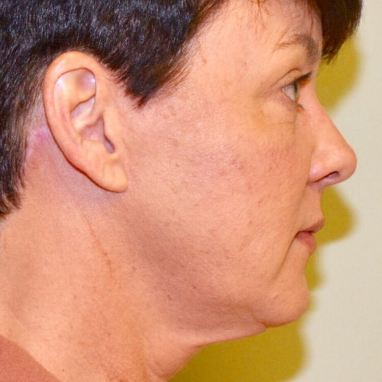 Facelift After Patient 2