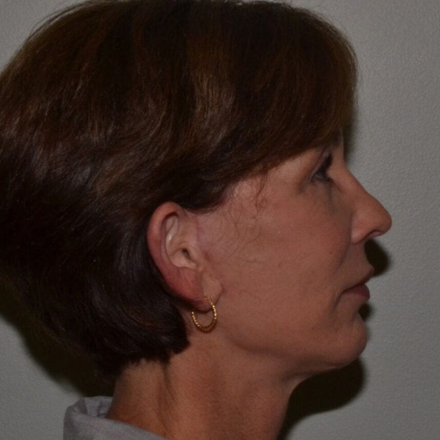 Facelift After Patient 4