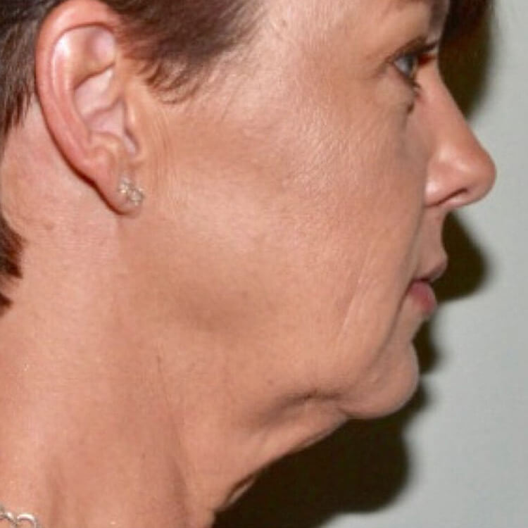 Facelift Before Patient 2