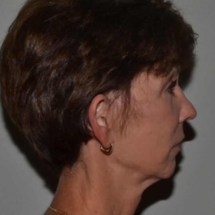 Facelift Before Patient 4