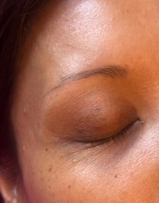 MedSpa / Non Surgical Before Patient 1