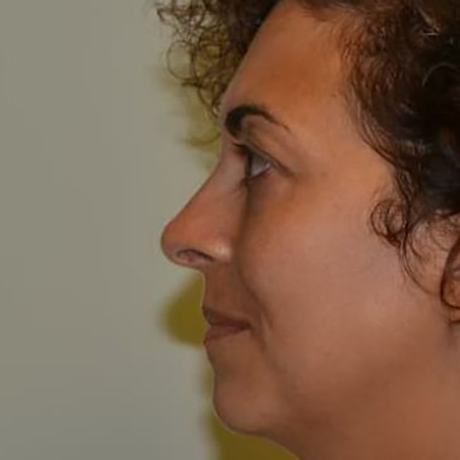 Rhinoplasty After Patient 2