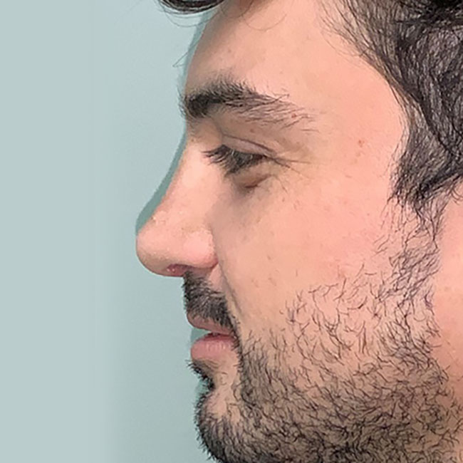 Rhinoplasty After Patient 1