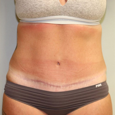 Tummy Tuck After Patient 1