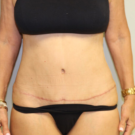 Tummy Tuck After Patient 2