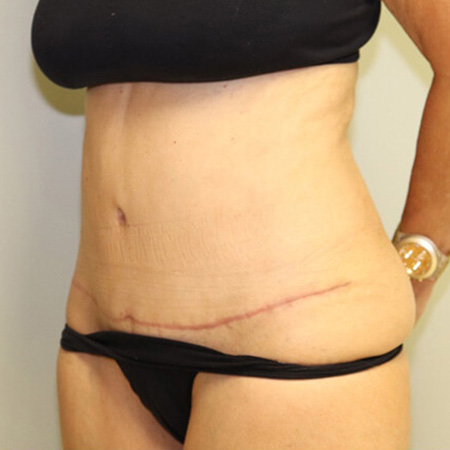 Tummy Tuck After Patient 3