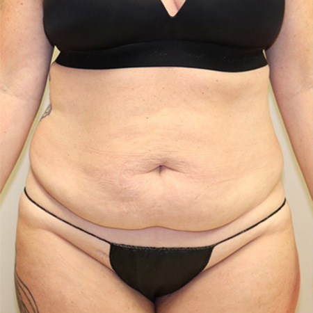 Tummy Tuck Before Patient 1