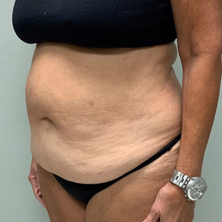 Tummy Tuck Before Patient 3