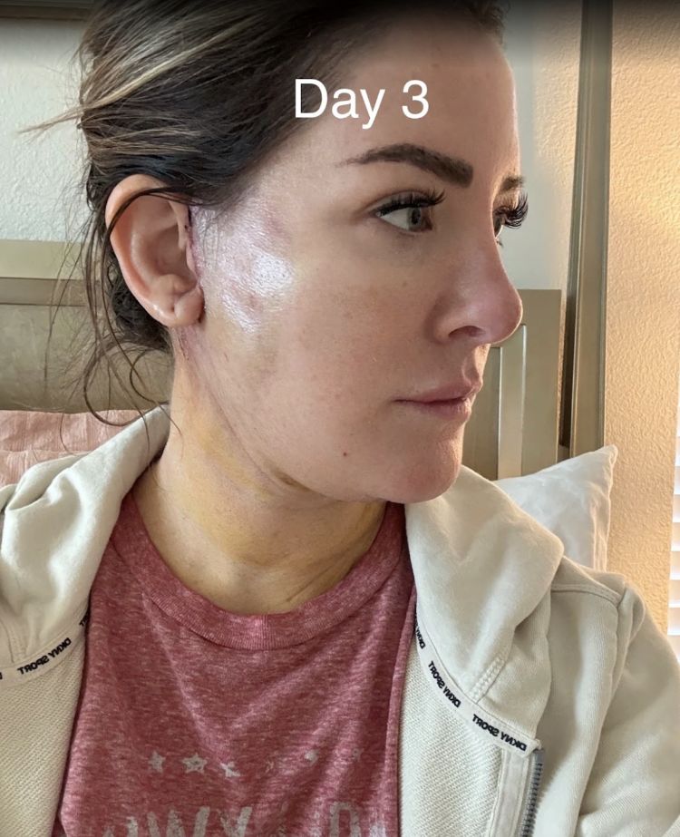 Recovery photos from day 3
