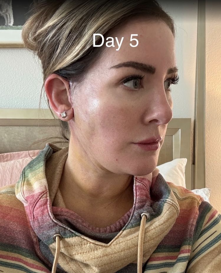 Recovery photos from day 5