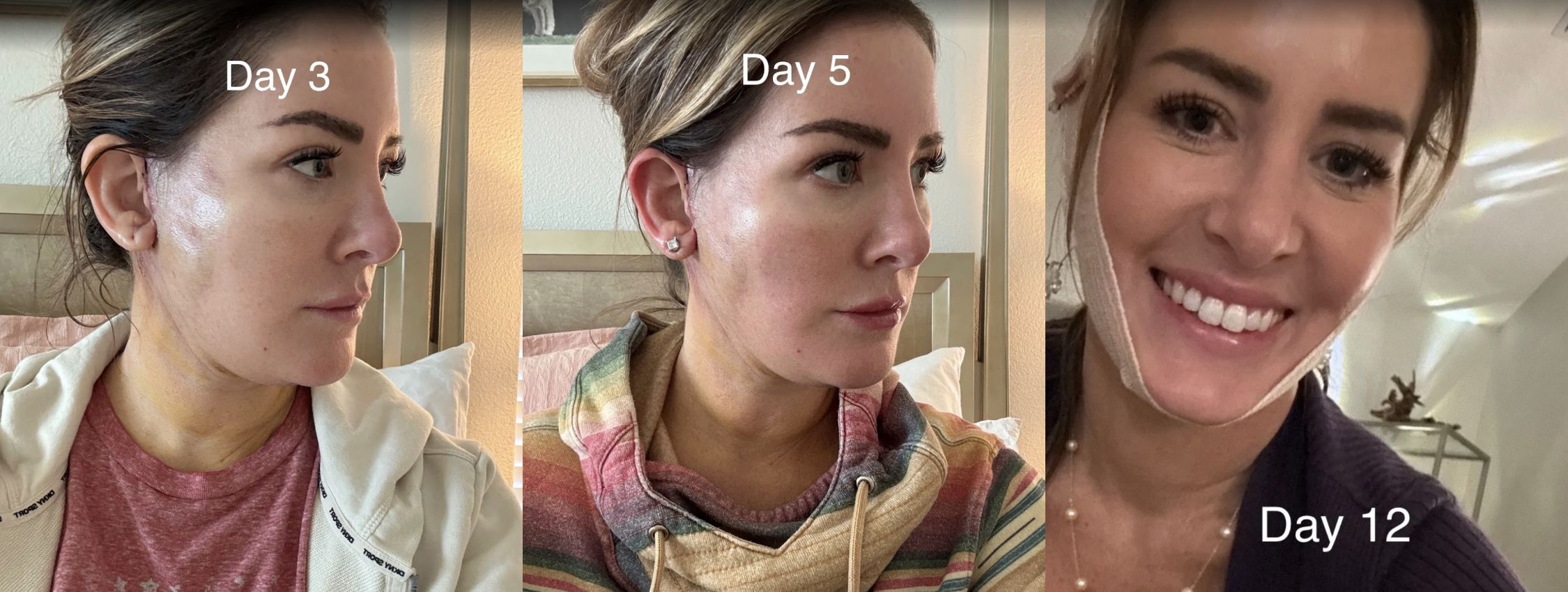 Recovery photos from day 3, 5, and 12 of a woman who had a lower facelift 