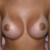 Case--1748 | After Breast Augmentation